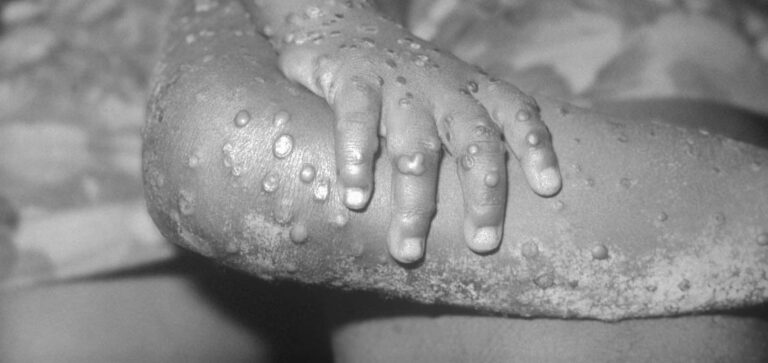 Crece en España el número de casos de viruela del mono y comprará vacunas